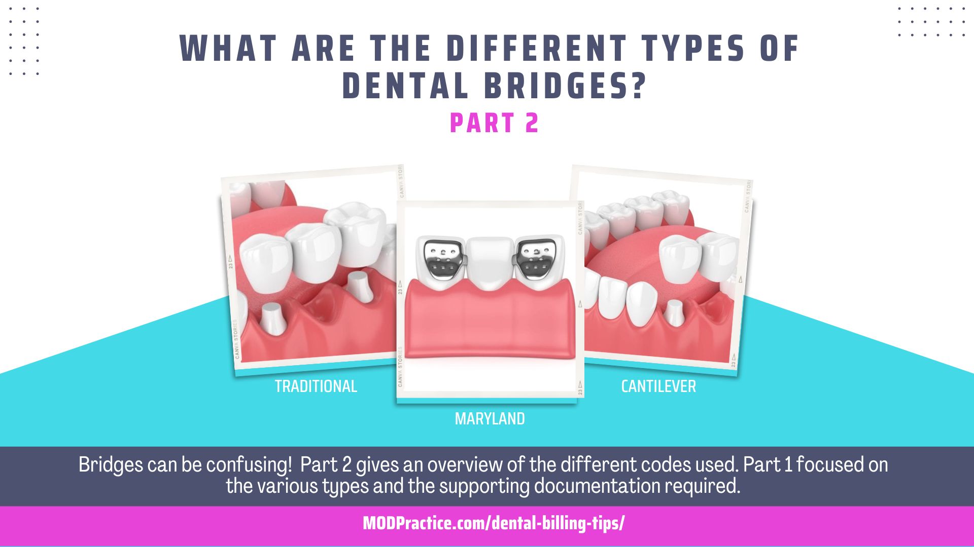 Dental Bridge Parts